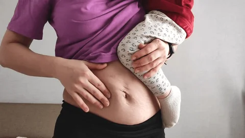 Liposuction After Pregnancy