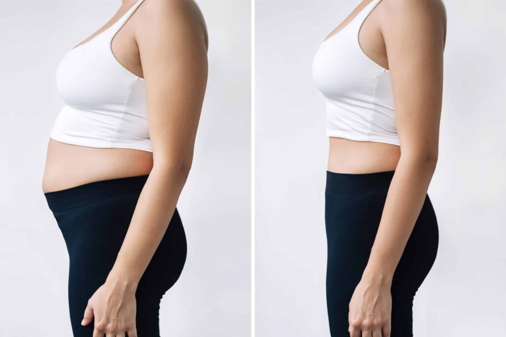 Liposuction After Pregnancy: The Core Considerations